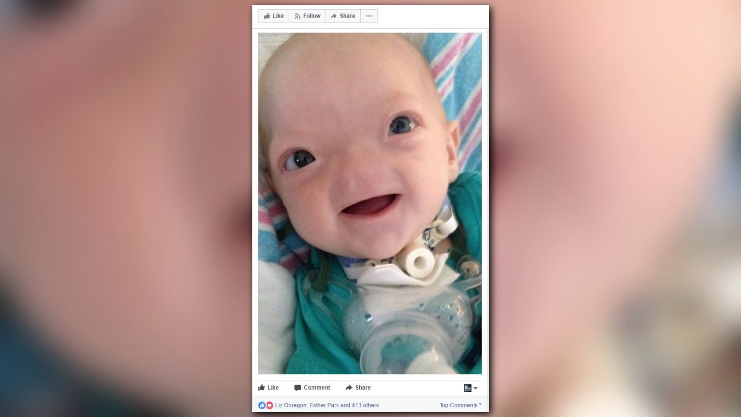 Eli Thompson, 'miracle baby' born without nose, dies at 2yearsold